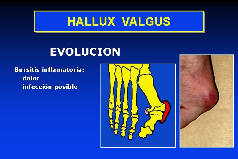 HALLUX VALGUS EVOLUCION Bursitis inflamatoria: dolor infección posible 