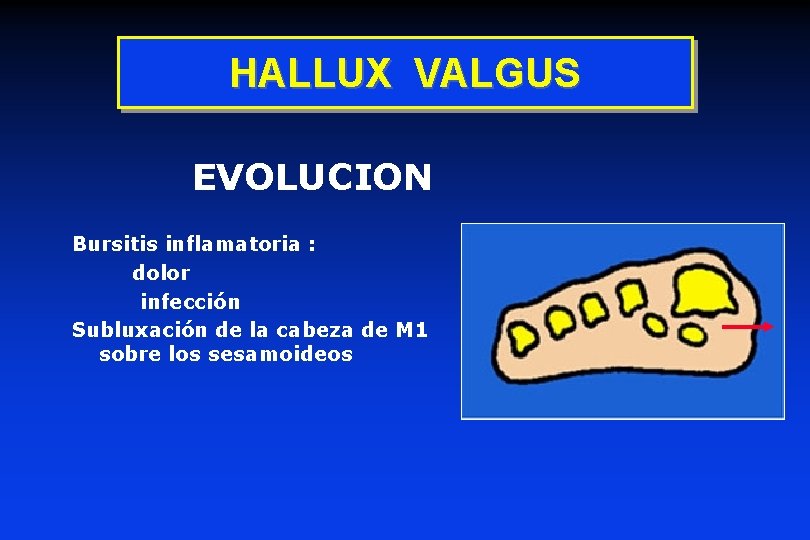 HALLUX VALGUS EVOLUCION Bursitis inflamatoria : dolor infección Subluxación de la cabeza de M