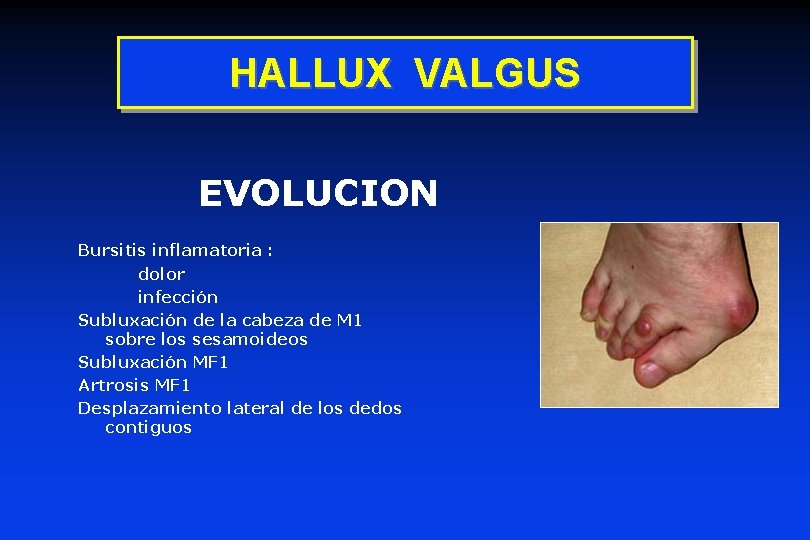 HALLUX VALGUS EVOLUCION Bursitis inflamatoria : dolor infección Subluxación de la cabeza de M