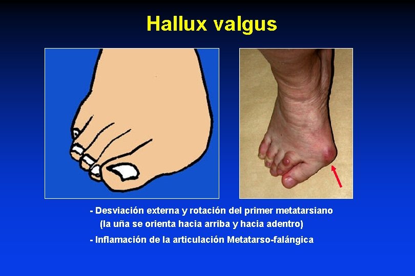 Hallux valgus - Desviación externa y rotación del primer metatarsiano (la uña se orienta