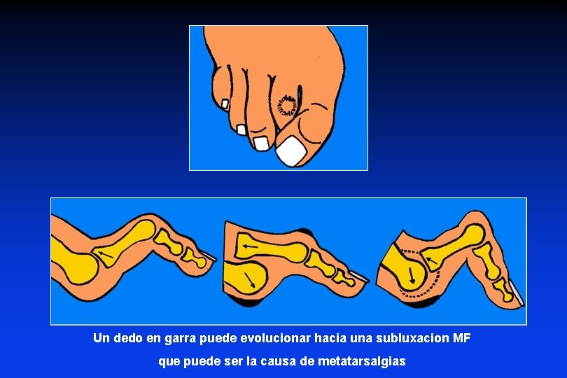 Un dedo en garra puede evolucionar hacia una subluxacion MF que puede ser la