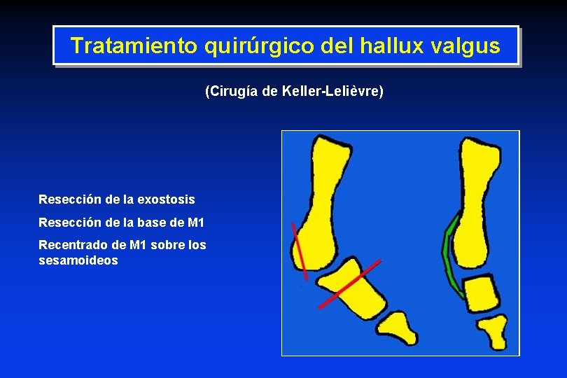 Tratamiento quirúrgico del hallux valgus (Cirugía de Keller-Lelièvre) Resección de la exostosis Resección de