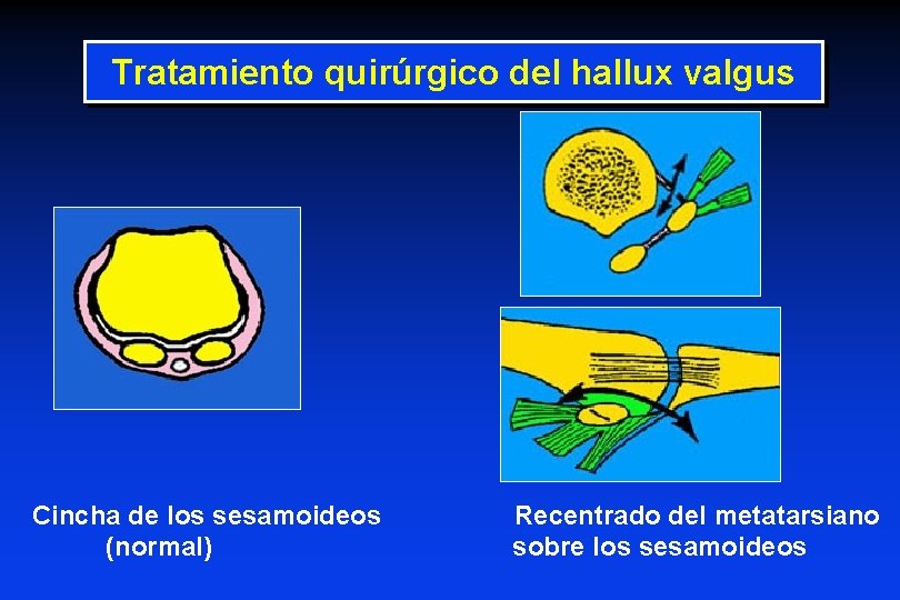 Tratamiento quirúrgico del hallux valgus Cincha de los sesamoideos (normal) Recentrado del metatarsiano sobre