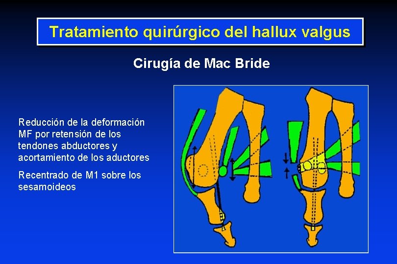 Tratamiento quirúrgico del hallux valgus Cirugía de Mac Bride Reducción de la deformación MF