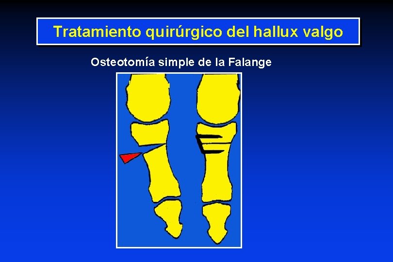 Tratamiento quirúrgico del hallux valgo Osteotomía simple de la Falange 