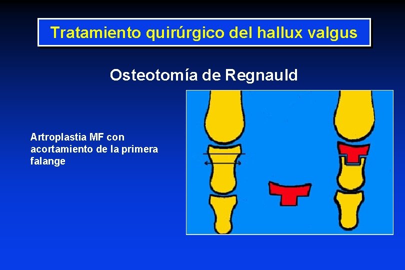 Tratamiento quirúrgico del hallux valgus Osteotomía de Regnauld Artroplastia MF con acortamiento de la