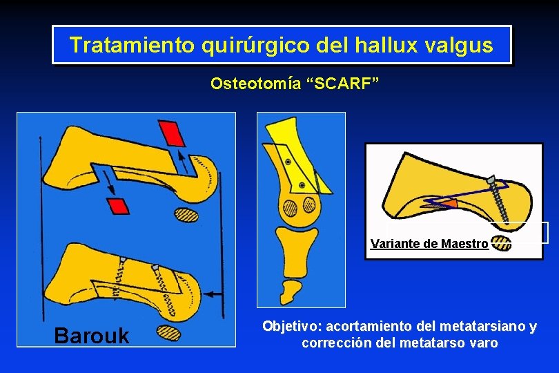 Tratamiento quirúrgico del hallux valgus Osteotomía “SCARF” Variante de Maestro Barouk Objetivo: acortamiento del