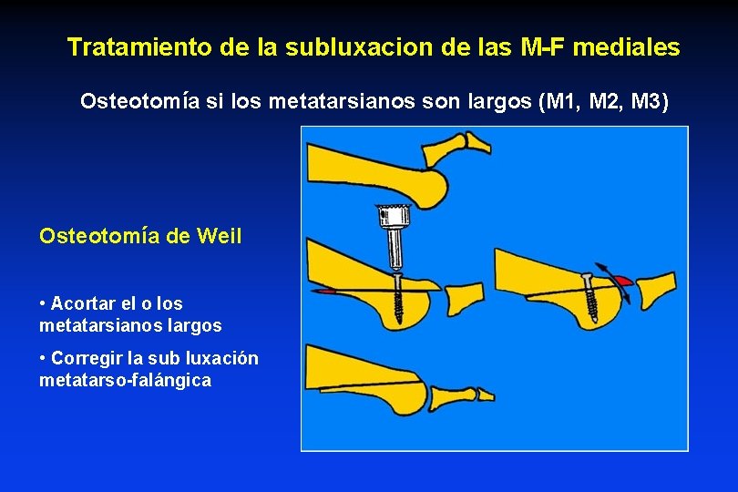 Tratamiento de la subluxacion de las M-F mediales Osteotomía si los metatarsianos son largos