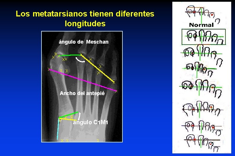 Los metatarsianos tienen diferentes longitudes ángulo de Meschan Ancho del antepié ángulo C 1