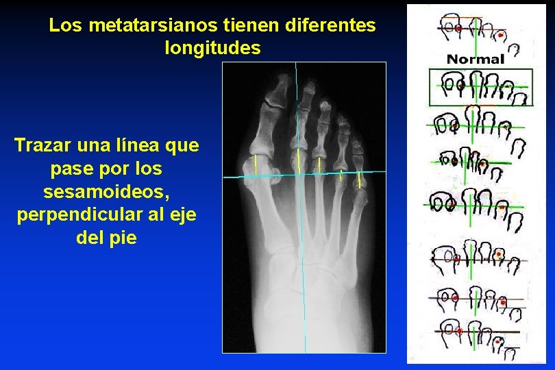 Los metatarsianos tienen diferentes longitudes Trazar una línea que pase por los sesamoideos, perpendicular