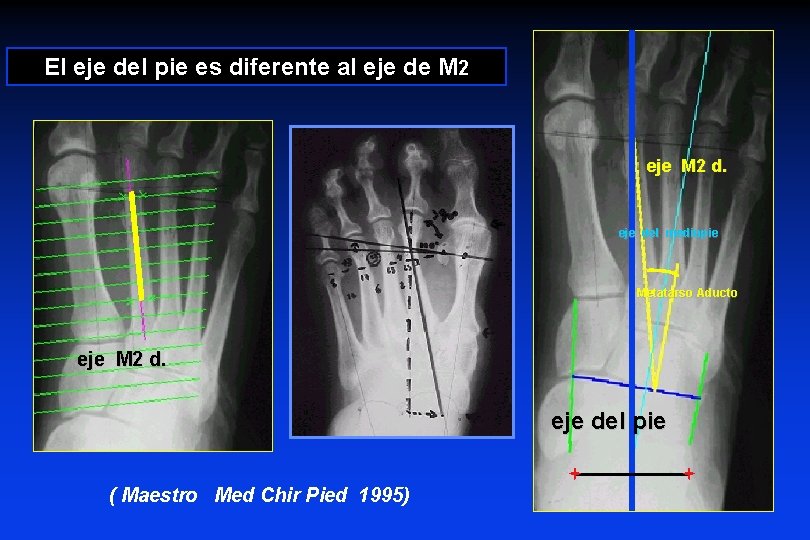 El eje del pie es diferente al eje de M 2 eje M 2