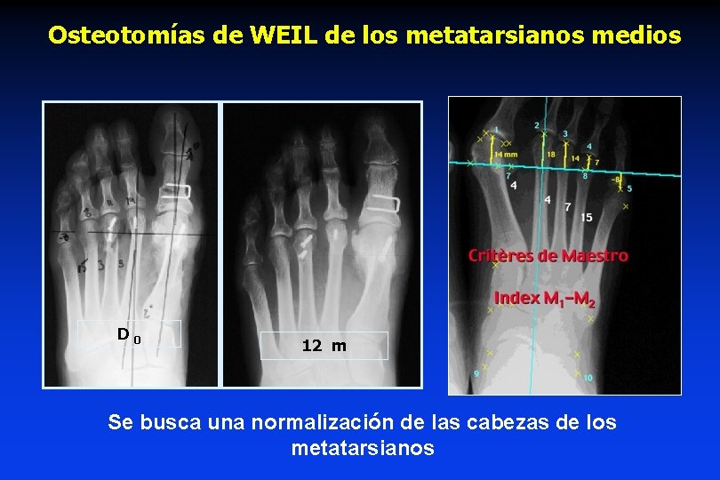 Osteotomías de WEIL de los metatarsianos medios D 0 12 m Se busca una