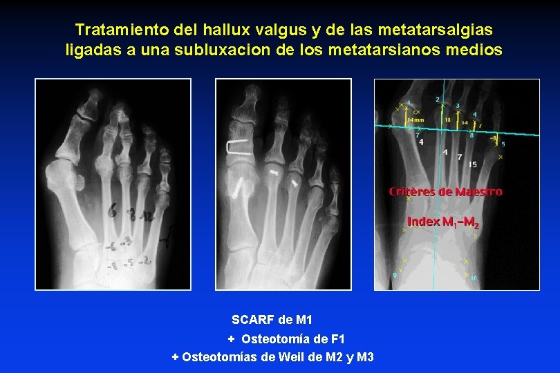 Tratamiento del hallux valgus y de las metatarsalgias ligadas a una subluxacion de los