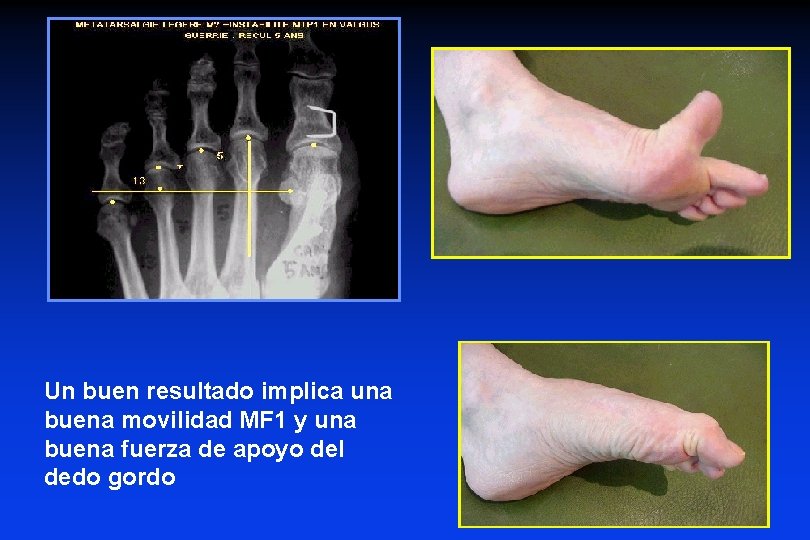 Un buen resultado implica una buena movilidad MF 1 y una buena fuerza de