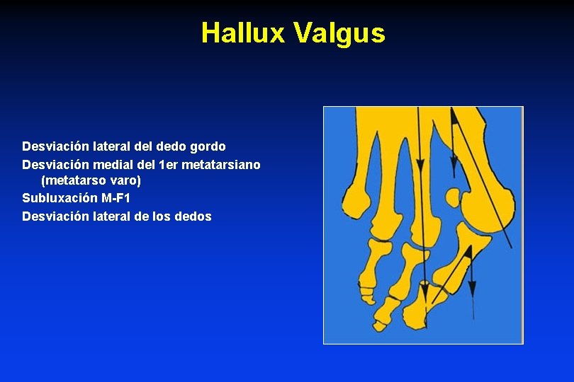 Hallux Valgus Desviación lateral dedo gordo Desviación medial del 1 er metatarsiano (metatarso varo)