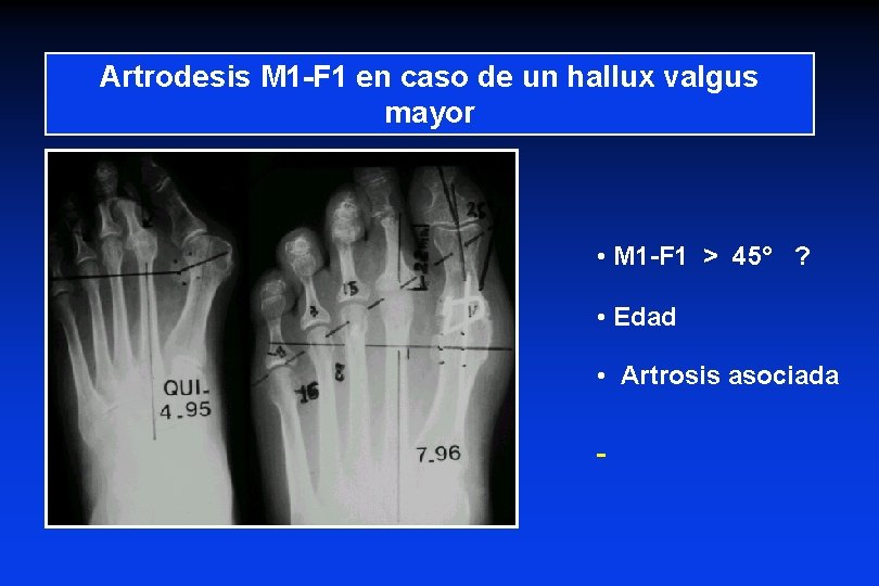 Artrodesis M 1 -F 1 en caso de un hallux valgus mayor • M