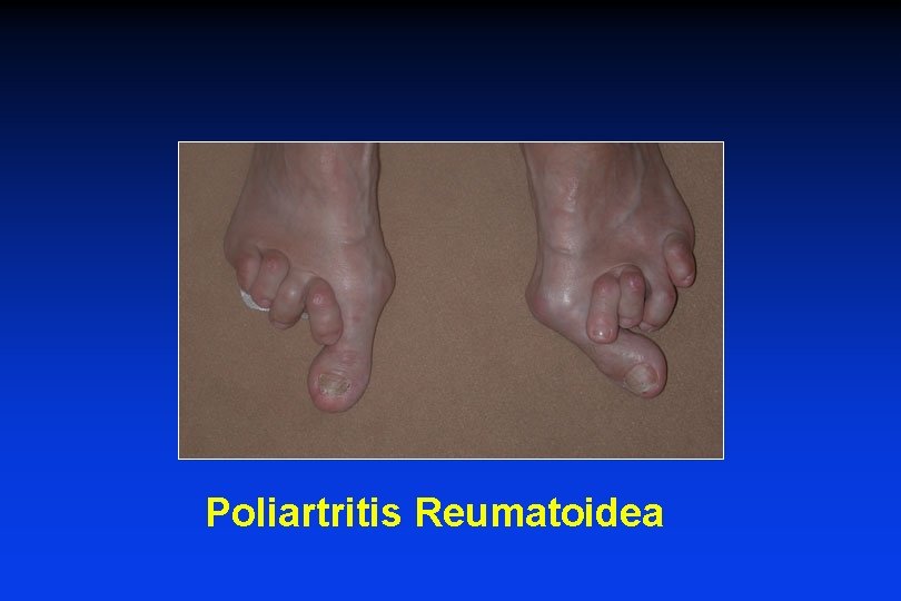 Poliartritis Reumatoidea 