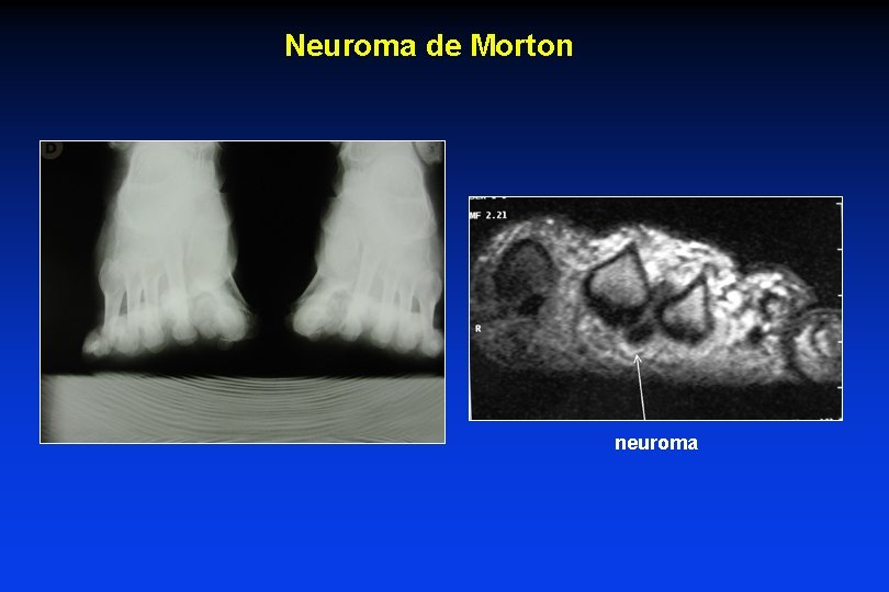 Neuroma de Morton neuroma 