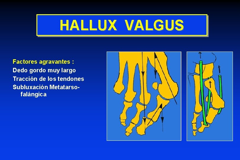 HALLUX VALGUS Factores agravantes : Dedo gordo muy largo Tracción de los tendones Subluxación