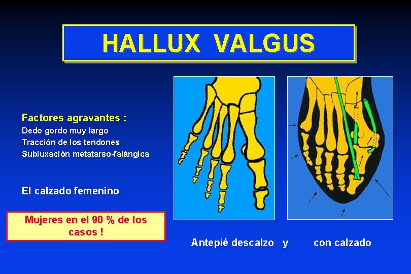 HALLUX VALGUS Factores agravantes : Dedo gordo muy largo Tracción de los tendones Subluxación