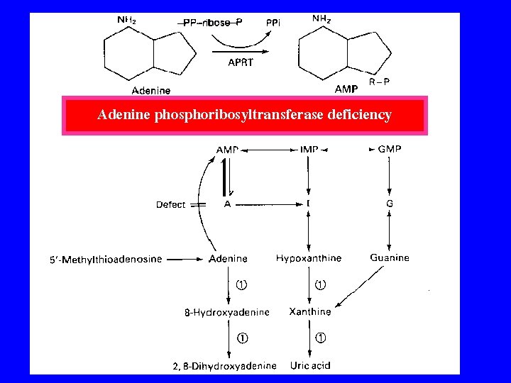 Adenine phosphoribosyltransferase deficiency 