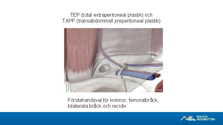 TEP (total extraperitoneal plastik) och TAPP (transabdominell preperitoneal plastik) Förstahandsval för kvinnor, femoralbråck, bilaterala