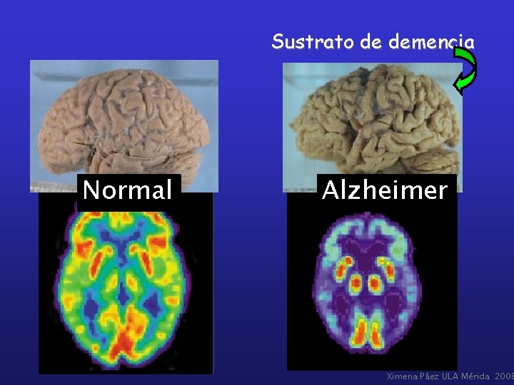 Sustrato de demencia Normal Alzheimer Ximena Páez ULA Mérida 2008 