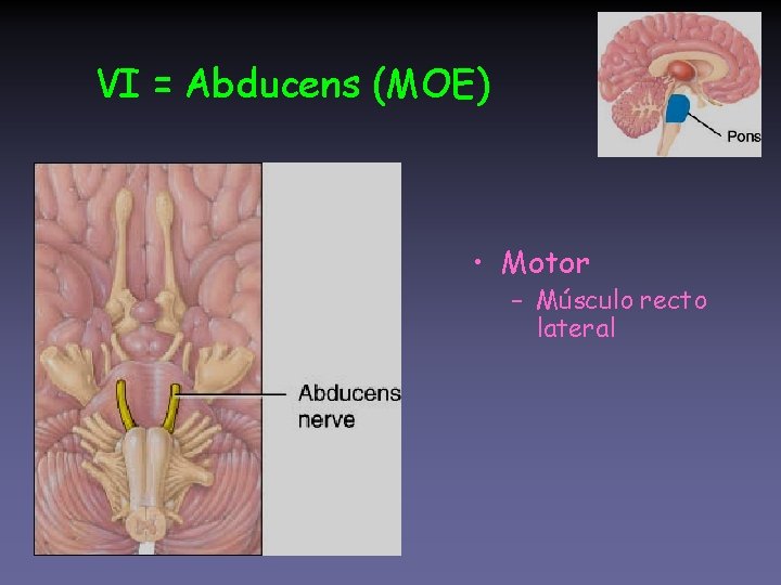 VI = Abducens (MOE) • Motor – Músculo recto lateral 