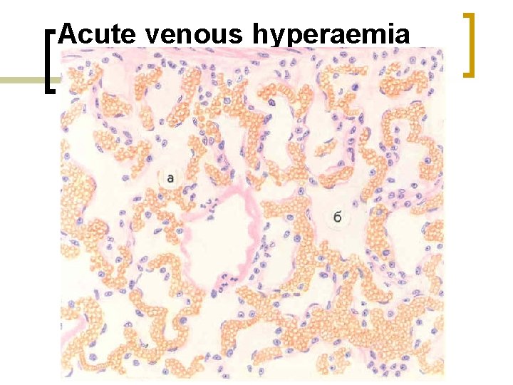 Acute venous hyperaemia 
