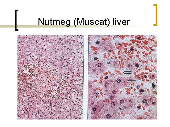 Nutmeg (Muscat) liver 