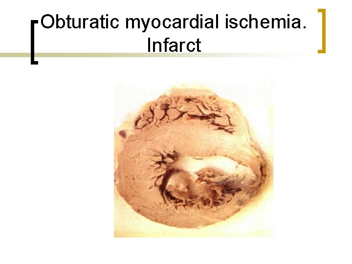 Obturatic myocardial ischemia. Infarct 