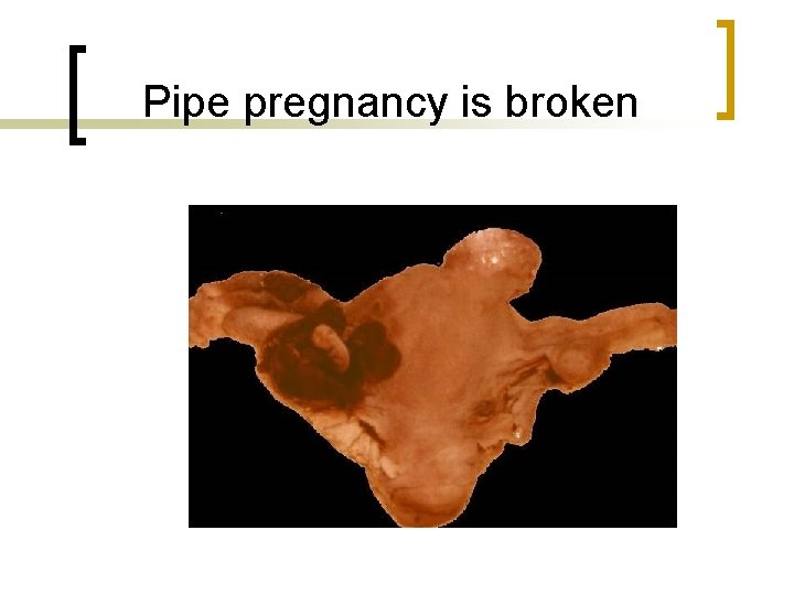 Pipe pregnancy is broken 
