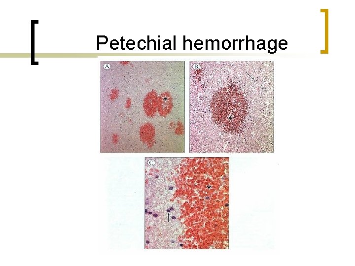 Petechial hemorrhage 