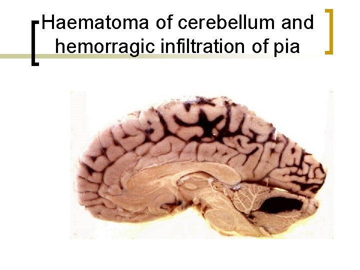 Haematoma of cerebellum and hemorragic infiltration of pia 