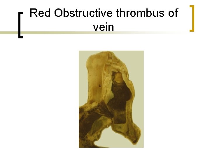 Red Obstructive thrombus of vein 