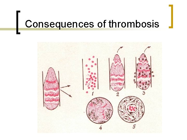 Consequences of thrombosis 