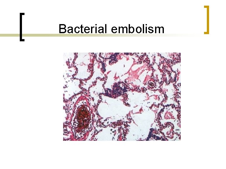 Bacterial embolism 