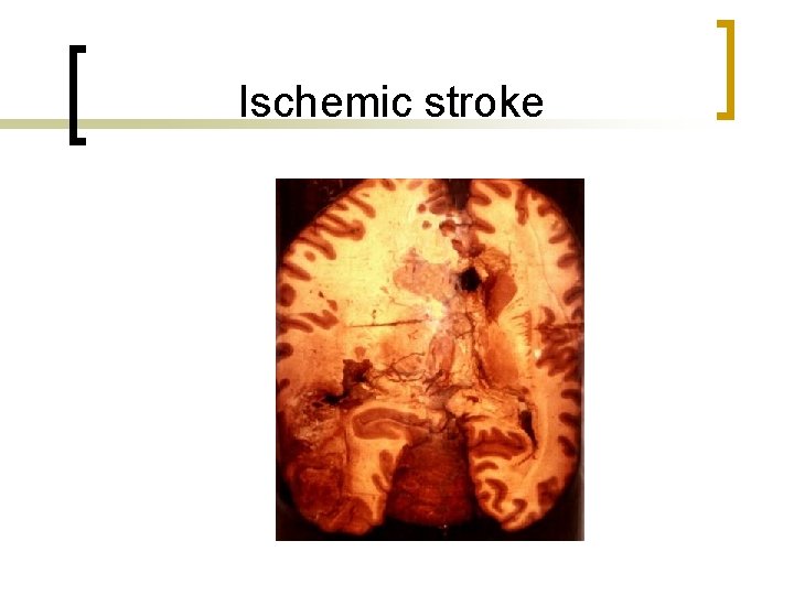 Ischemic stroke 