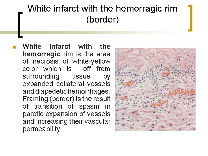 White infarct with the hemorragic rim (border) n White infarct with the hemorragic rim