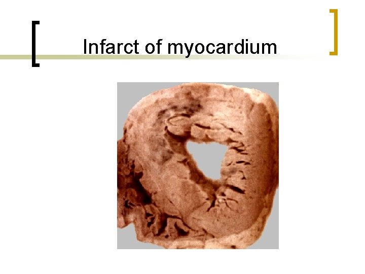 Infarct of myocardium 