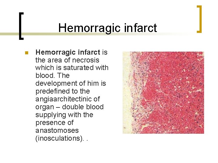 Hemorragic infarct n Hemorragic infarct is the area of necrosis which is saturated with