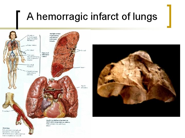 A hemorragic infarct of lungs 