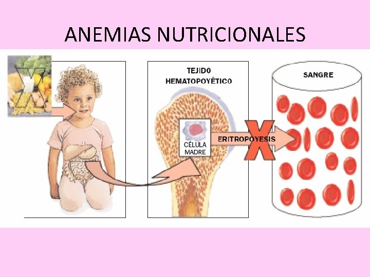 ANEMIAS NUTRICIONALES 