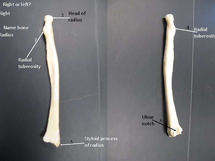 Right or left? Right 3 Head of radius 2 Name bone Radius 4 Radial