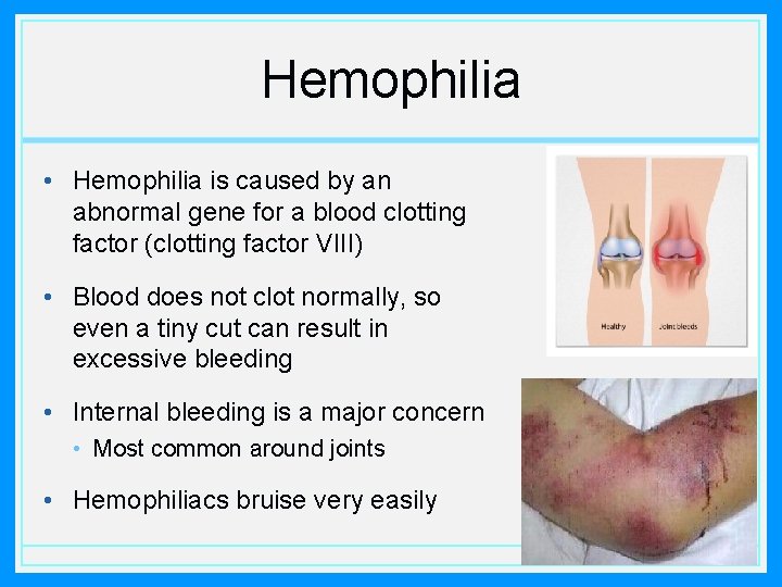 Hemophilia • Hemophilia is caused by an abnormal gene for a blood clotting factor