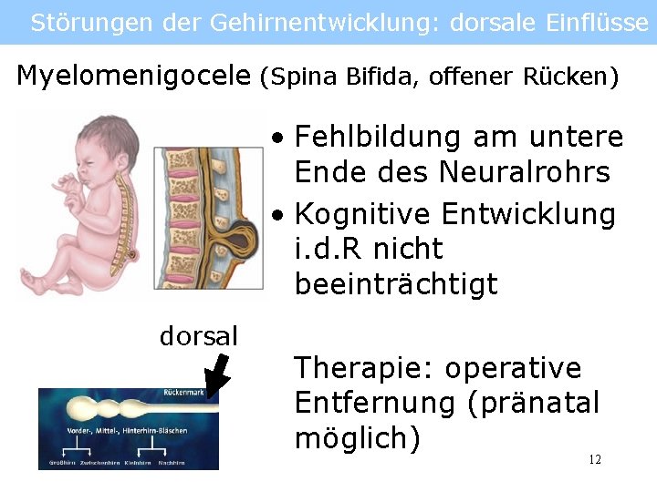 Störungen der Gehirnentwicklung: dorsale Einflüsse Myelomenigocele (Spina Bifida, offener Rücken) • Fehlbildung am untere