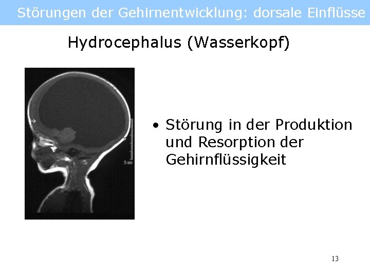 Störungen der Gehirnentwicklung: dorsale Einflüsse Hydrocephalus (Wasserkopf) • Störung in der Produktion und Resorption