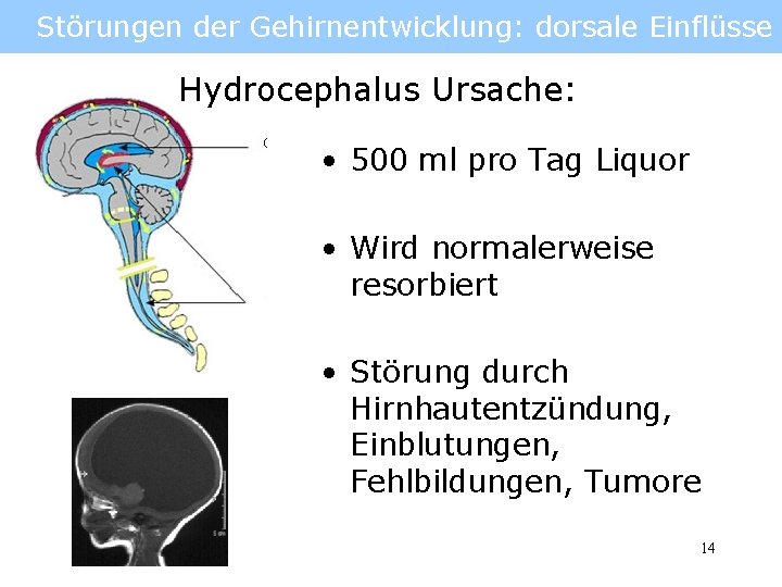 Störungen der Gehirnentwicklung: dorsale Einflüsse Hydrocephalus Ursache: • 500 ml pro Tag Liquor •