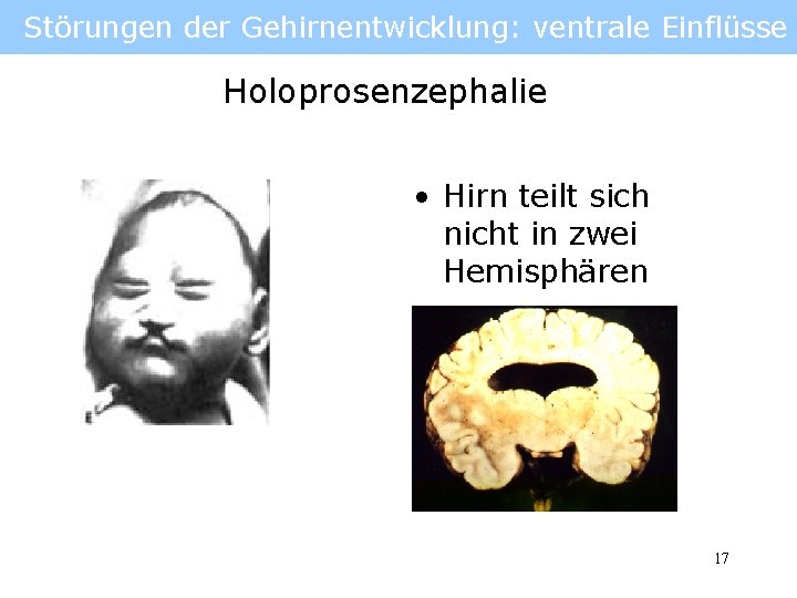 Störungen der Gehirnentwicklung: ventrale Einflüsse Holoprosenzephalie • Hirn teilt sich nicht in zwei Hemisphären