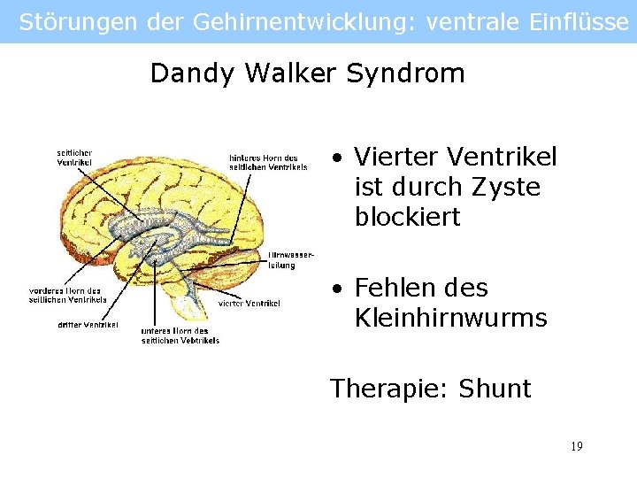 Störungen der Gehirnentwicklung: ventrale Einflüsse Dandy Walker Syndrom • Vierter Ventrikel ist durch Zyste